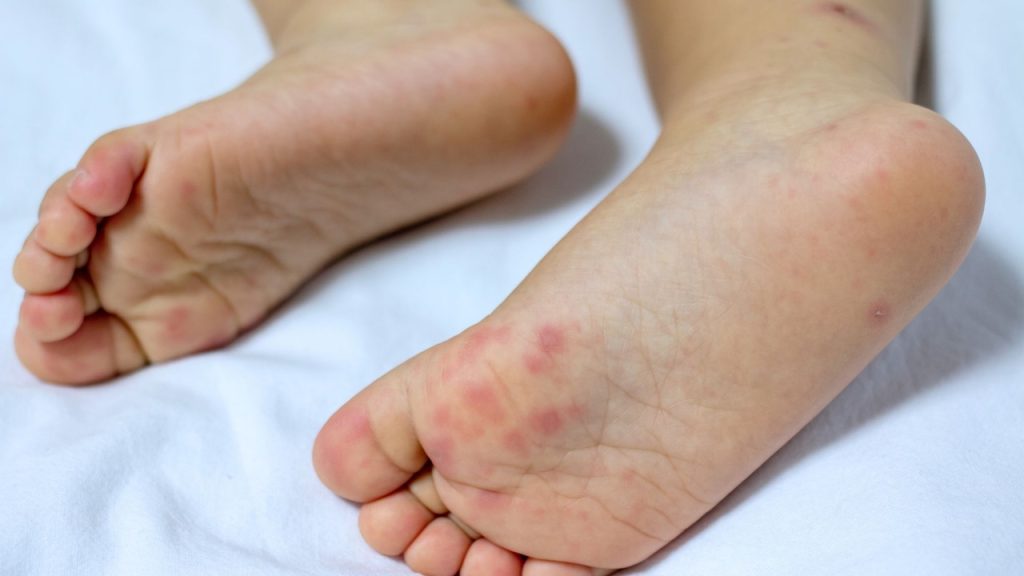 The summer illness that spreads quickly and parents of young children should be aware of