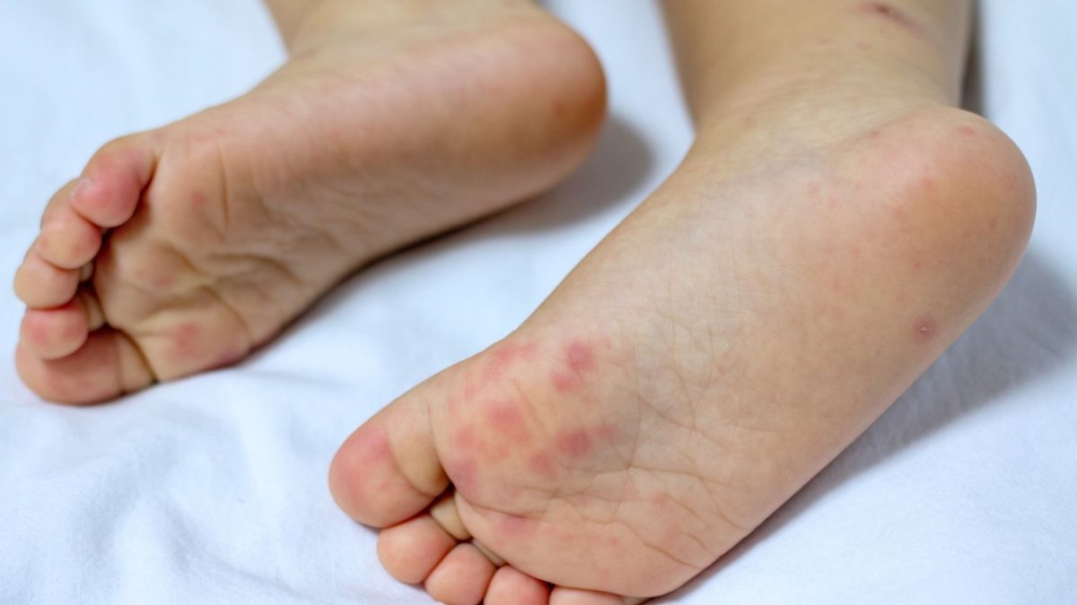 The summer illness that spreads quickly and parents of young children should be aware of