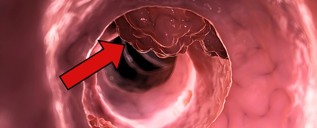 A Common Medication Might Prevent Colorectal Cancer From Coming Back