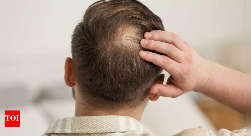 Bid farewell to bald spots: New drug pp405 may help you regrow your hair naturally