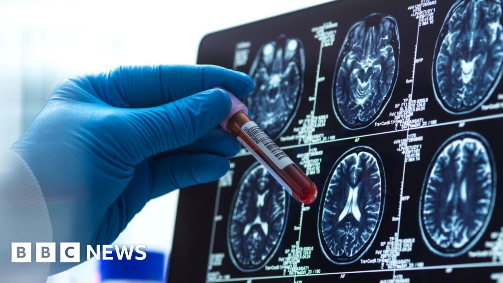 Blood test for Alzheimer's may change how the condition is diagnosed