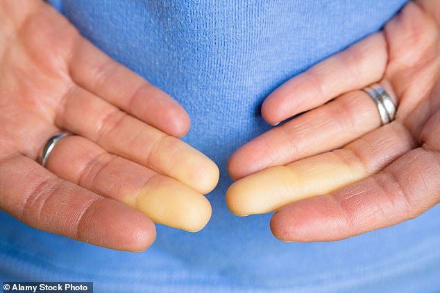 Doctors find a new possible treatment for a condition that causes extreme cold in the hands.