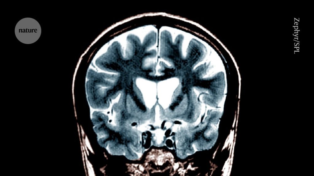 First use of gene therapy to treat Huntington’s disease