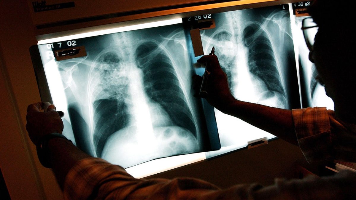 Maine reports 3 current TB cases, the most lethal infectious disease in the world