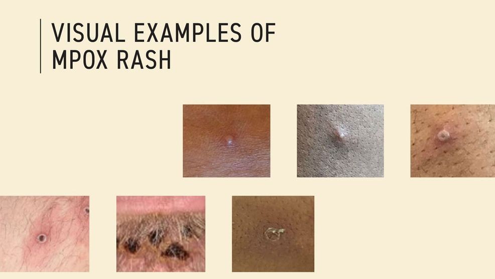 Mpox virus found in Pierce County wastewater