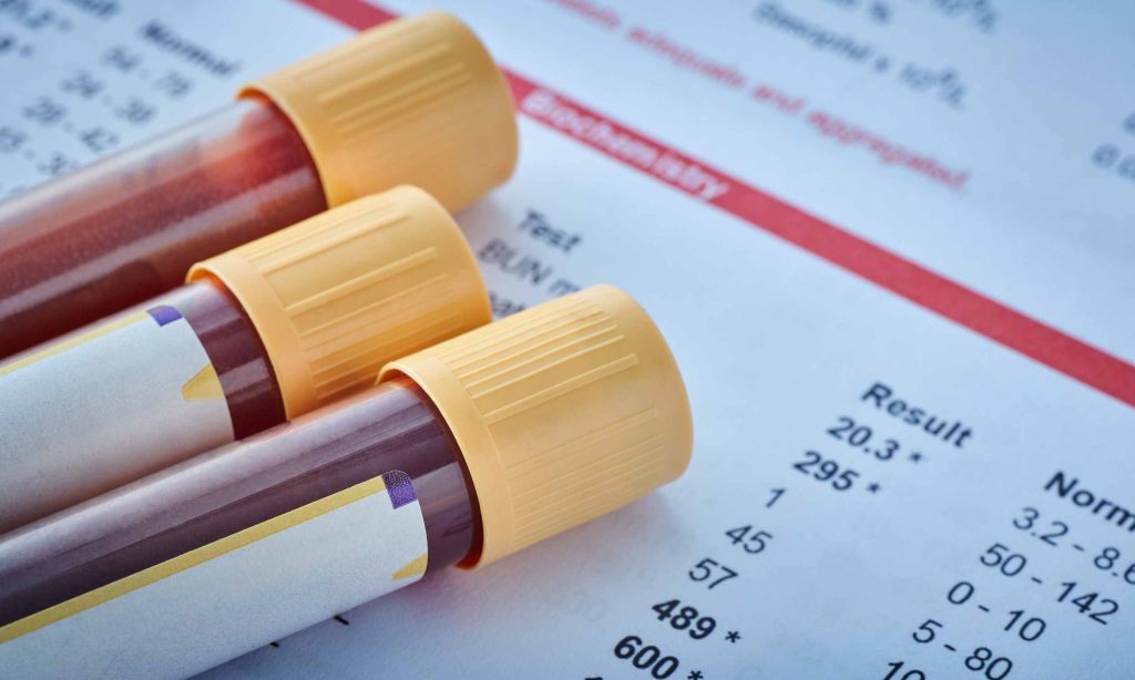 Quick blood test detects Alzheimer's disease in minutes