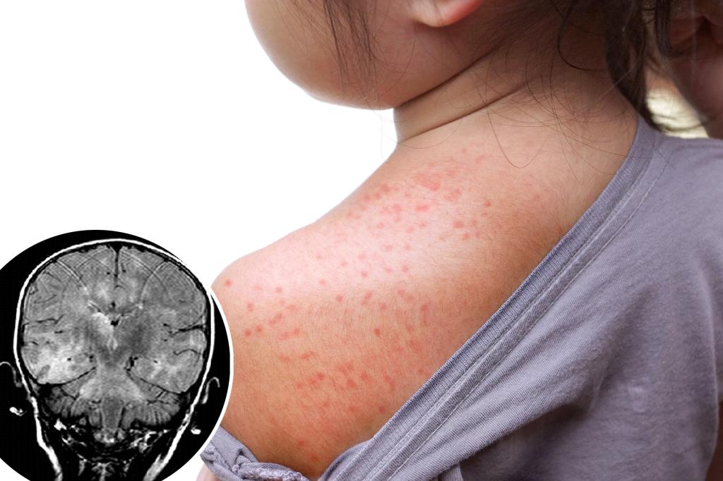 Serious brain disorder may emerge ten years after measles infection