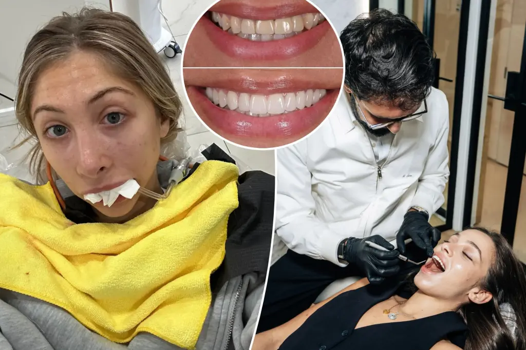 Stars popularized veneers as a fast cosmetic solution after the pandemic, but many are now regretting it: 'My mouth is permanently messed up'