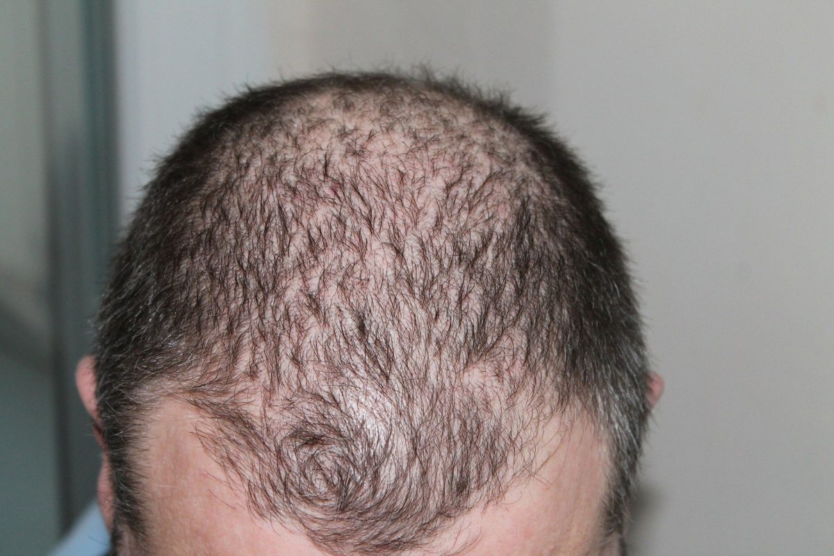Study indicates your diet may play a role in hair loss.