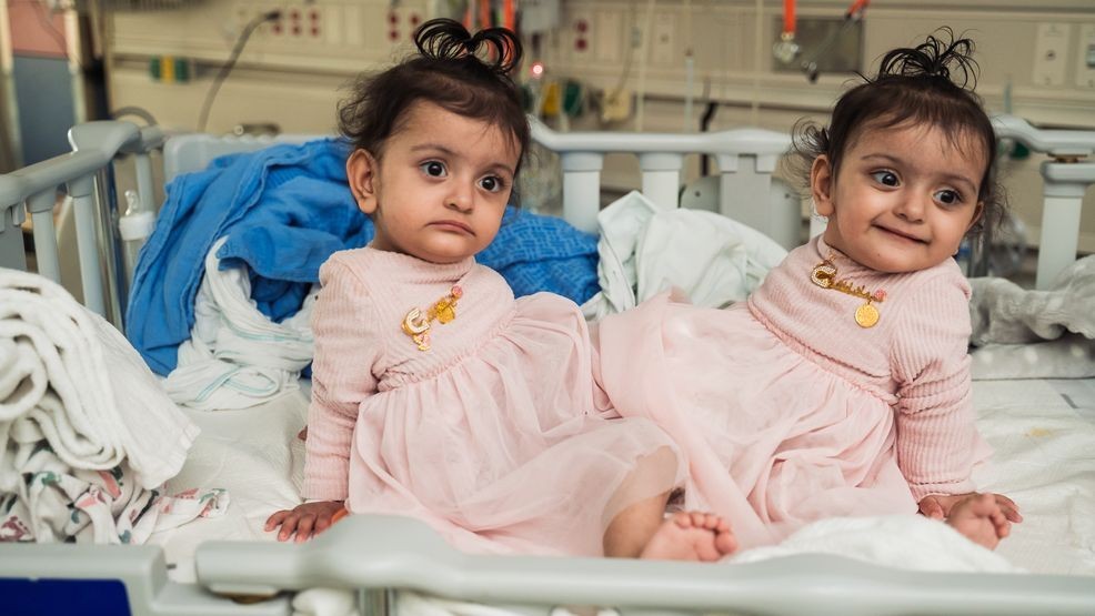 Surgery successfully separates conjoined twin girls at a children's hospital in Seattle.