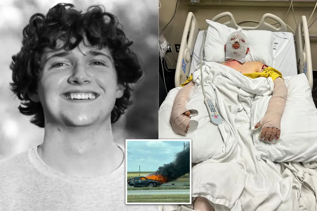 Texas college student sustains severe burns after being hit by a suspected drunk driver