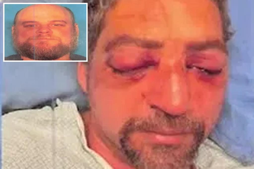 Vermont man nearly loses his sight after being attacked and having his eyes gouged out in a road rage incident