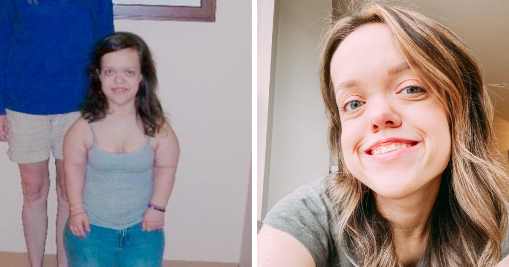 Young Person with Dwarfism Who Underwent Height Surgery Shows Stunning Appearance at 31