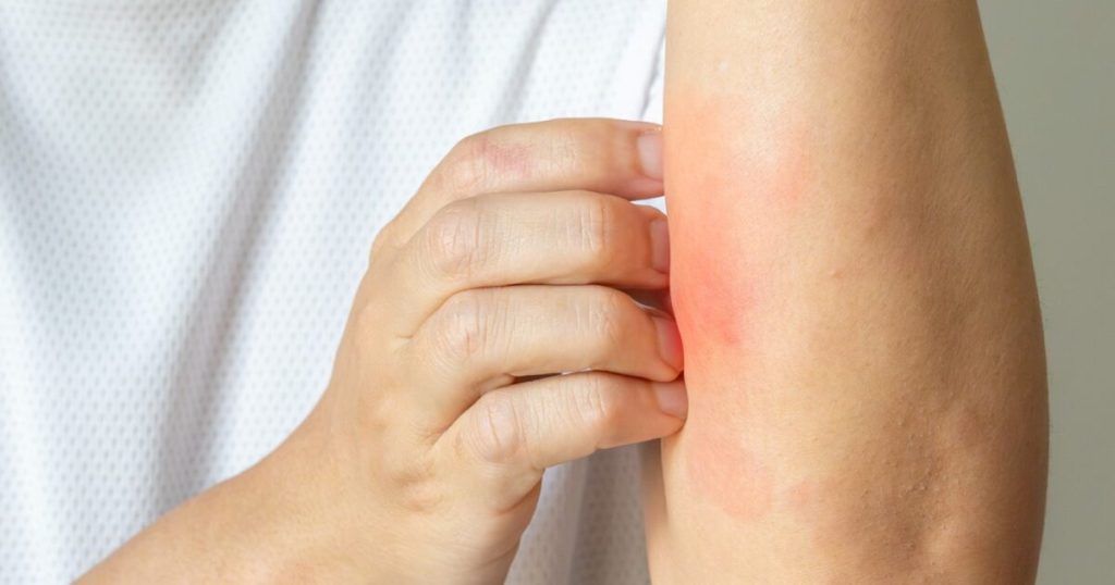 A Hopeful New Therapy for the 84 Million Americans Dealing with Skin Issues