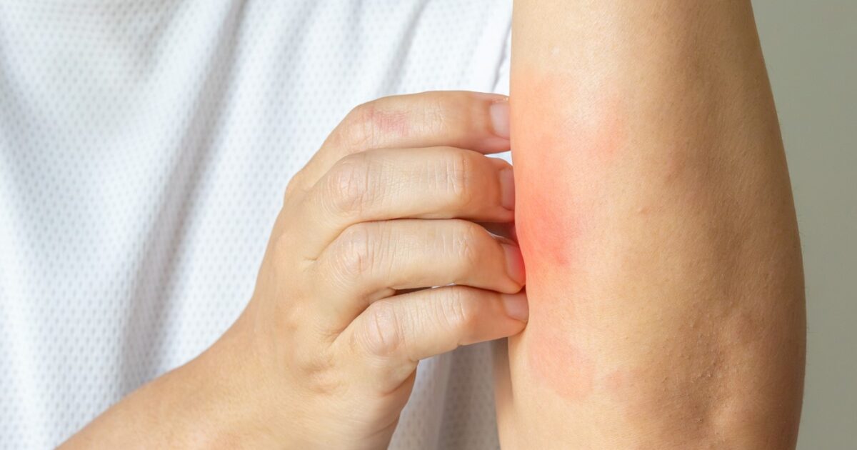 A Hopeful New Therapy for the 84 Million Americans Dealing with Skin Issues