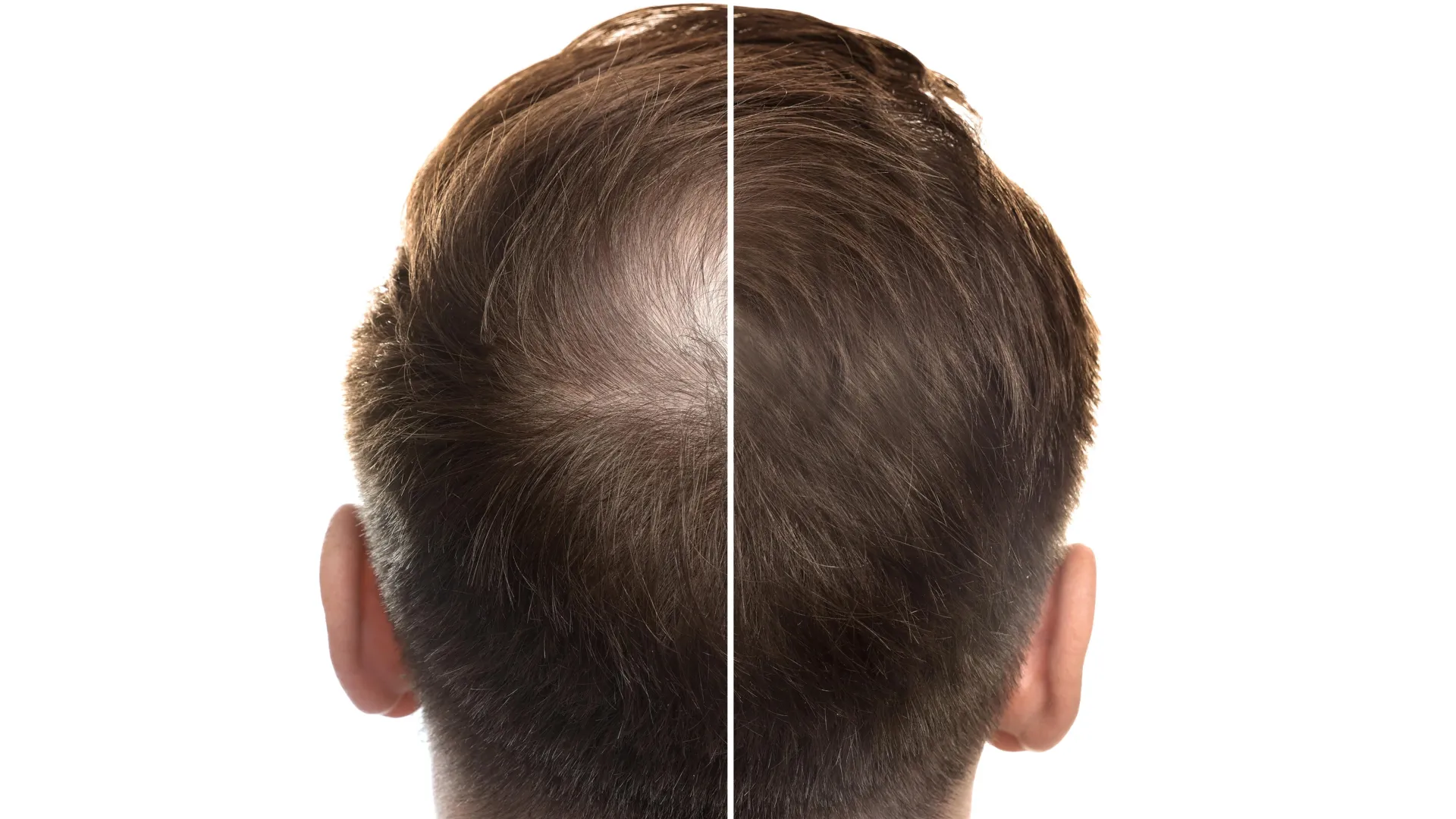 A sweet solution for hair loss? Stevia compound promotes hair growth ...