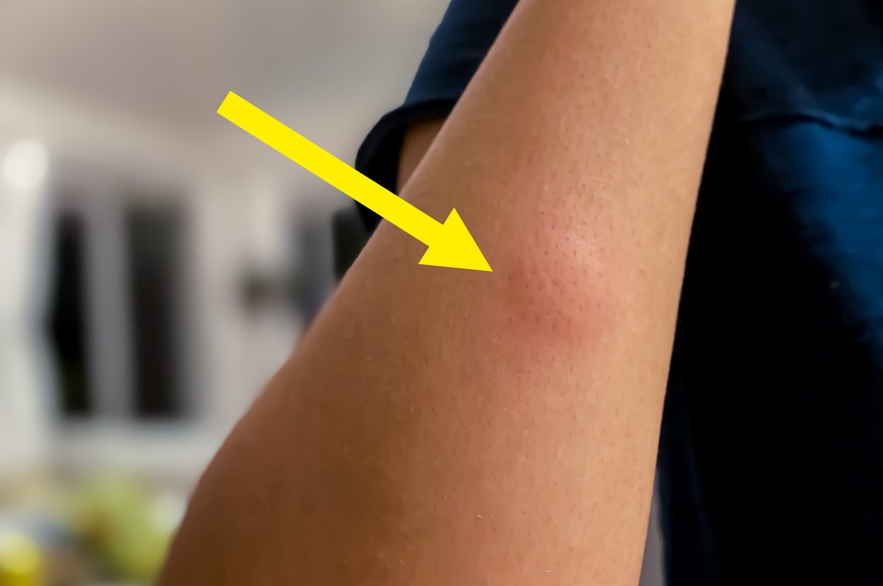 Avoid This After Getting Bitten by a Mosquito
