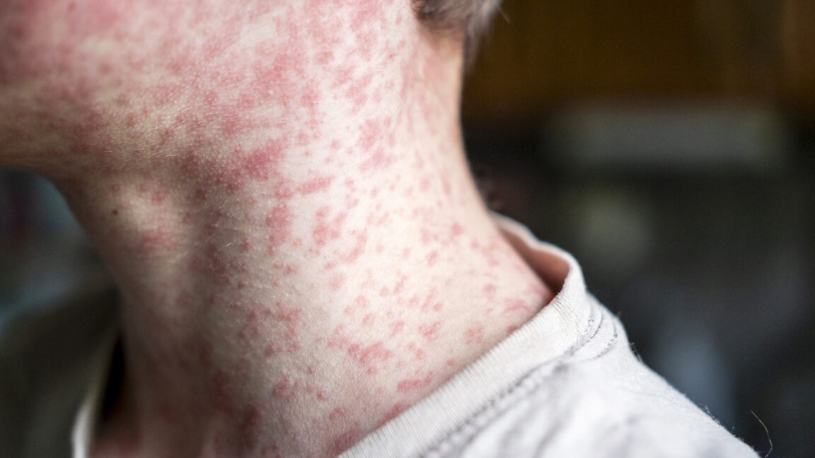 Investigation into measles outbreak in Utah hindered by uncooperative patient