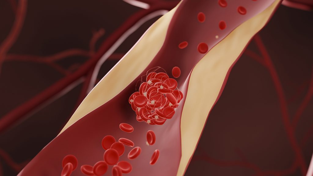 Medications thatLower Cholesterol Might Also Decrease the Risk of Dementia, According to a Large New Study