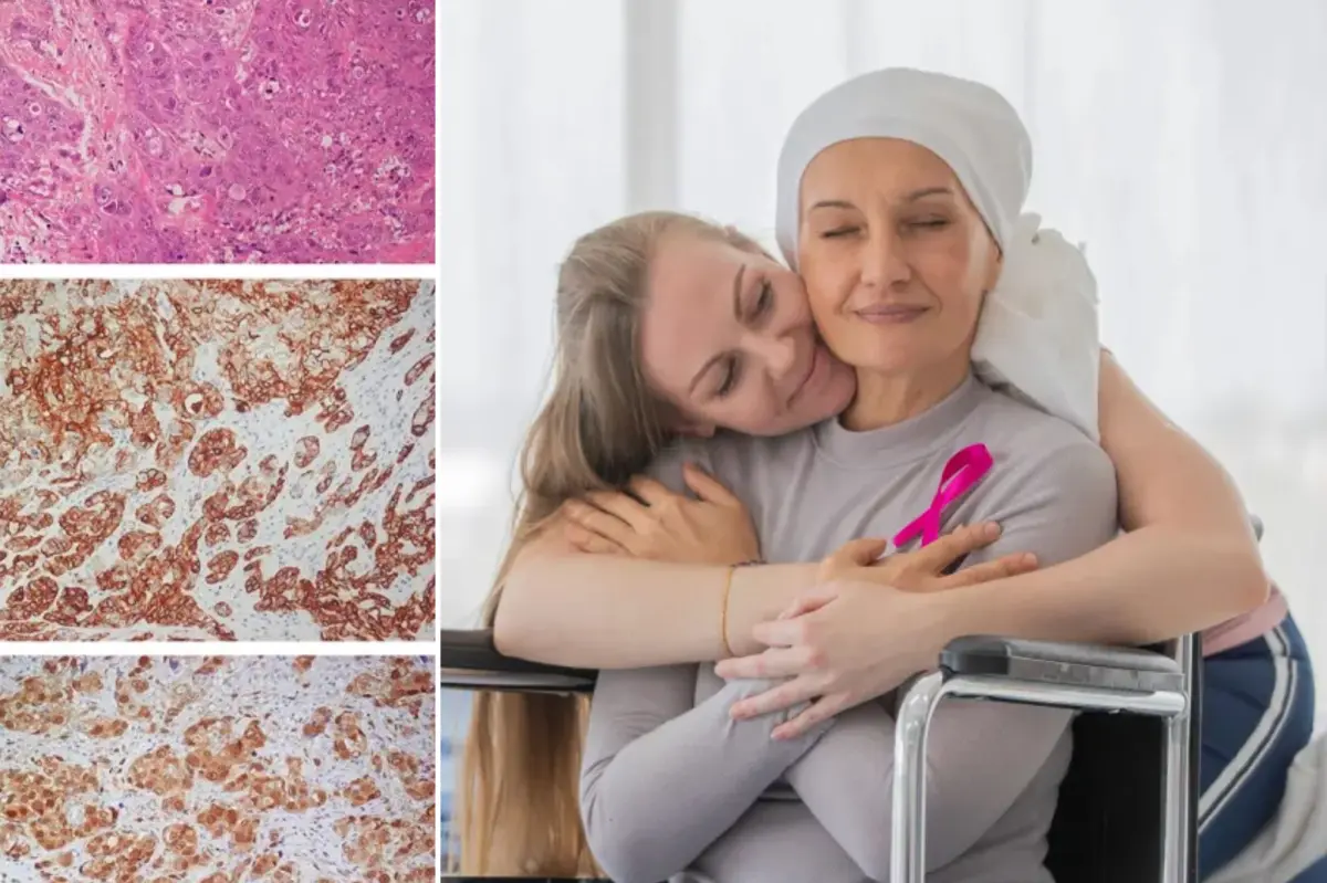 New drug more effective than chemotherapy for aggressive breast cancer