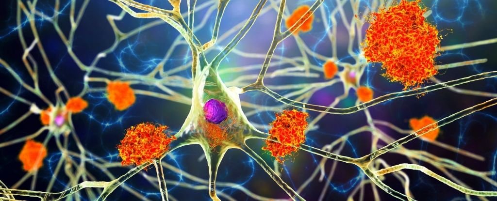 Research on 500,000 Medical Records Repeatedly Links Viruses to Alzheimer's