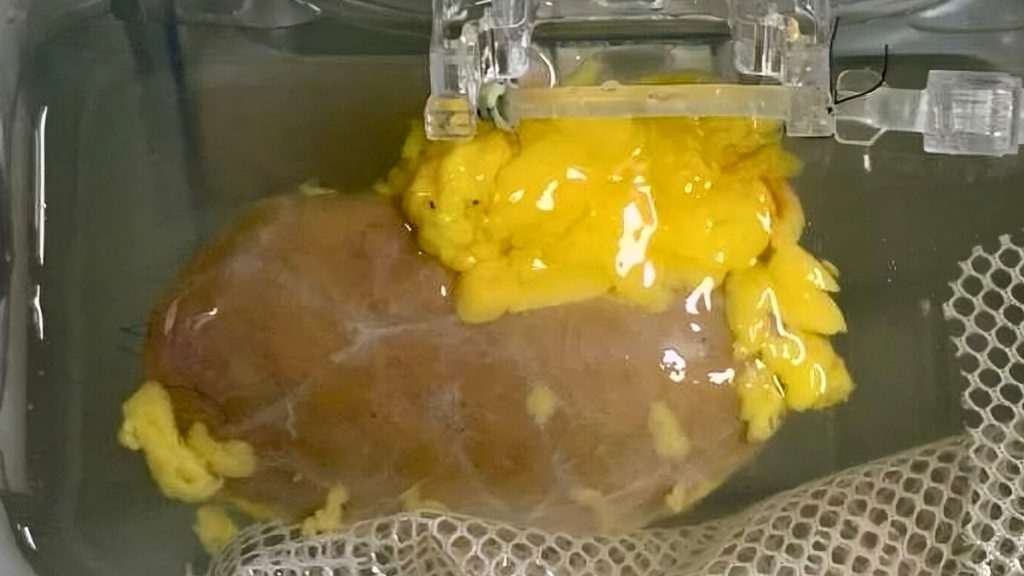 Researchers Develop 'Universal' Kidney Compatible With All Blood Types