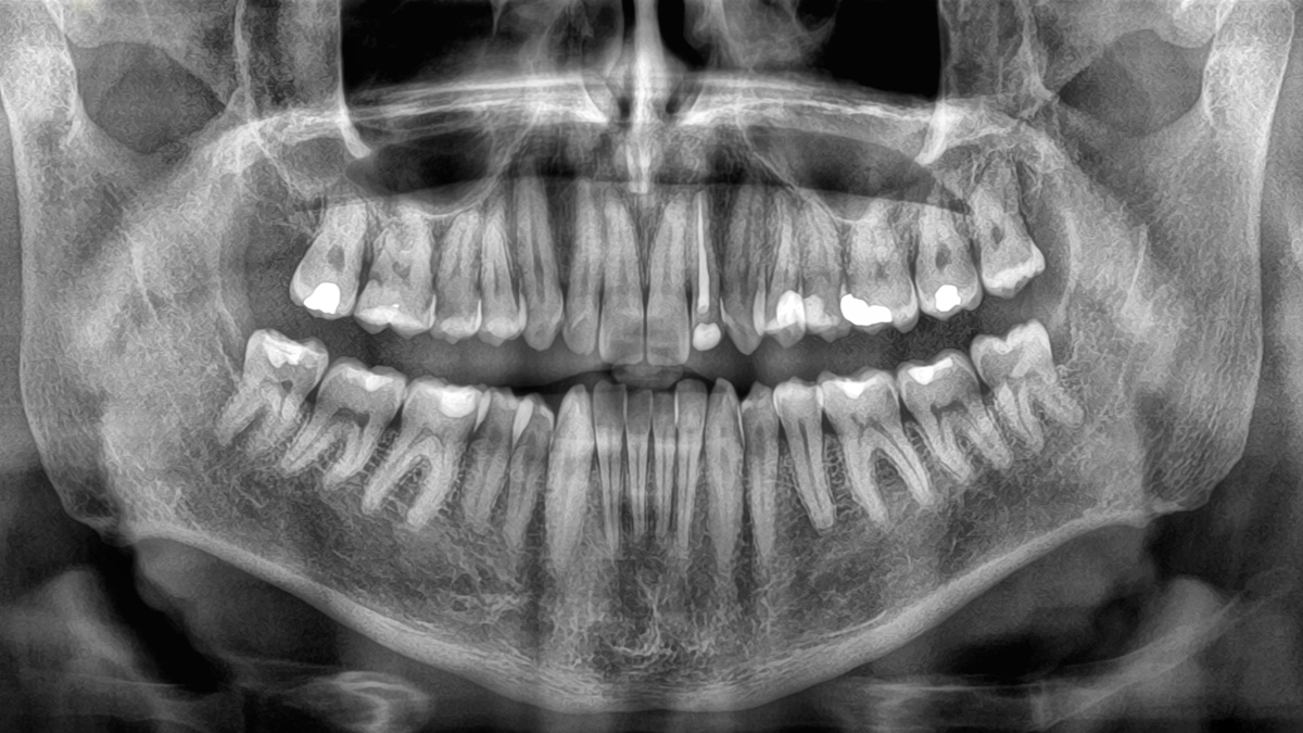 Teeth Nes The Loss of Teeth May Signal a Serious Health Risk, Research Shows ...