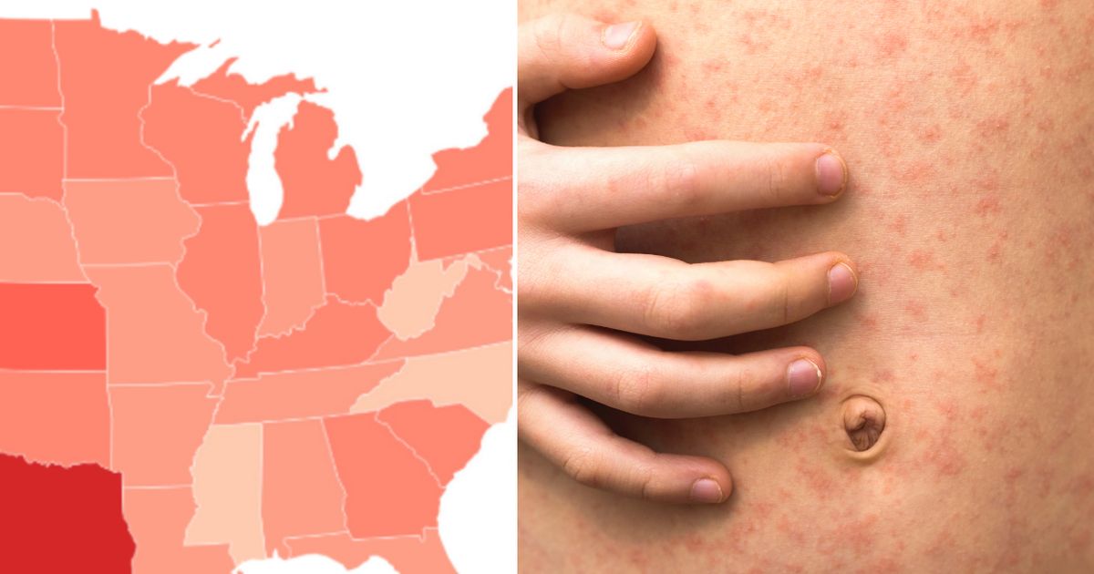The state experiencing the most measles cases amid a significant increase throughout the country