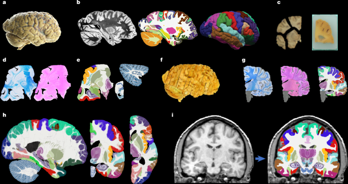 A probabilistic tissue map of the human brain for MRI analysis – TotalNEWS
