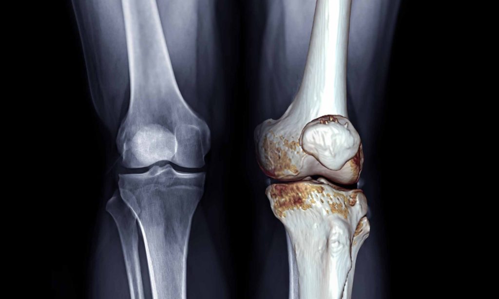 Drugs are not the most effective treatments for osteoarthritis