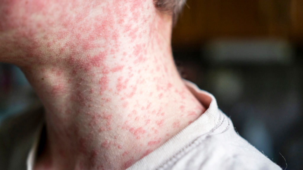 Experts warn that the US may lose its status of eliminating measles in the coming months.