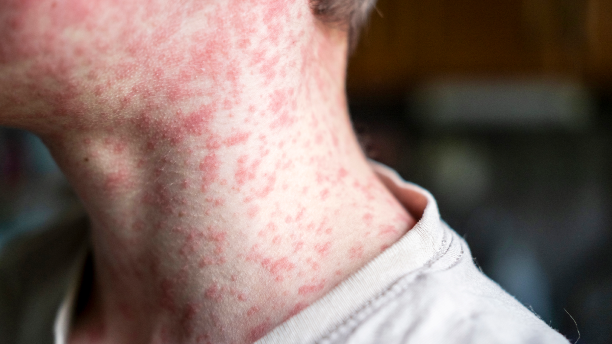 Experts warn that the US may lose its status of eliminating measles in the coming months.