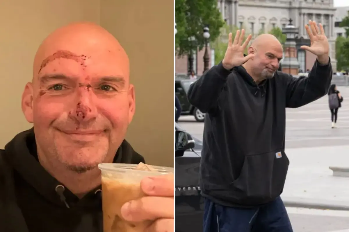 Fetterman posts image of his injured face after leaving the hospital following a fall