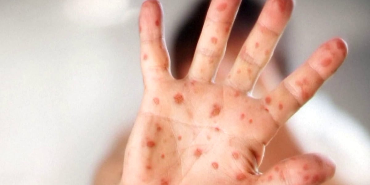 Measles exposure verified at GSP airport and a church in the Upstate