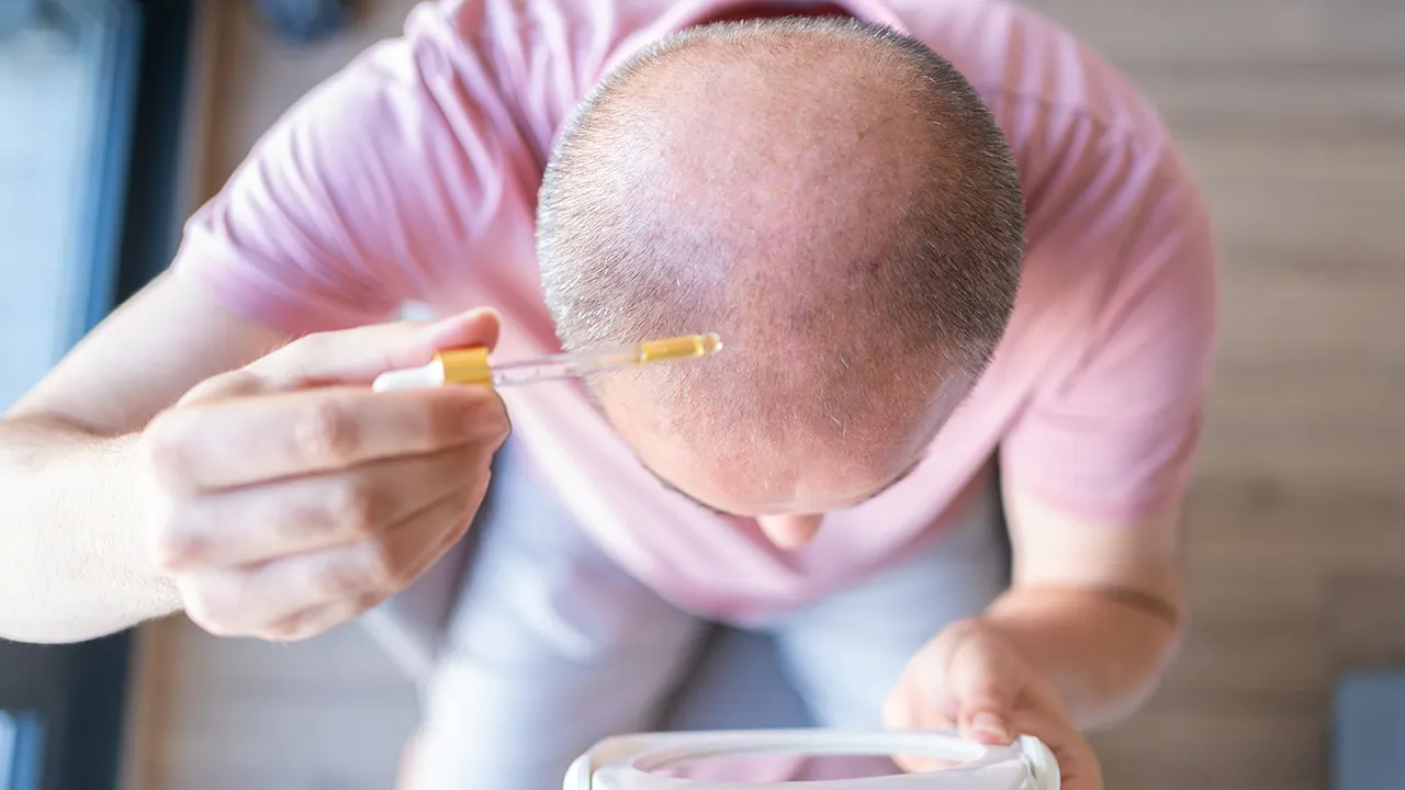 New hair loss treatment may help regrow hair in 20 days with serum application