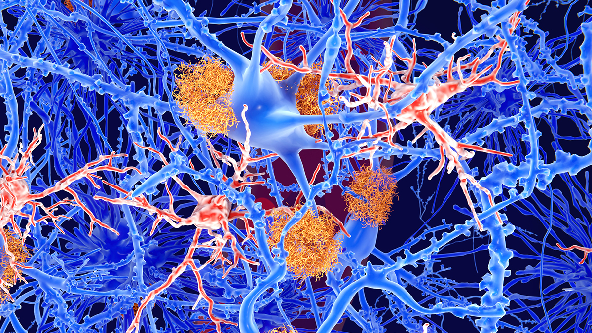 One of Our Greatest Hopes for Alzheimer's Treatment Appears Ineffective