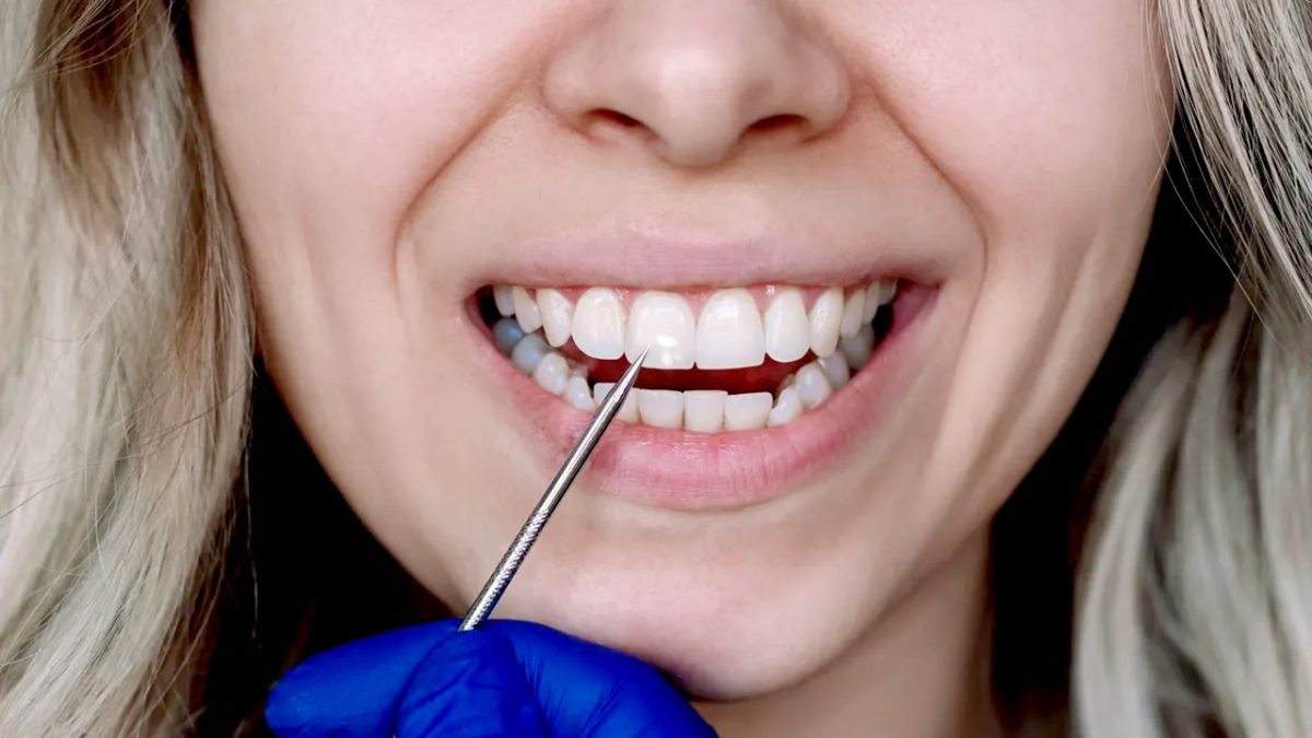 Researchers use proteins from human hair to restore damaged tooth enamel