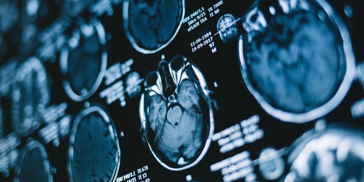 The "stuck in the present" aspect of ADHD might be linked to particular brain network interactions.