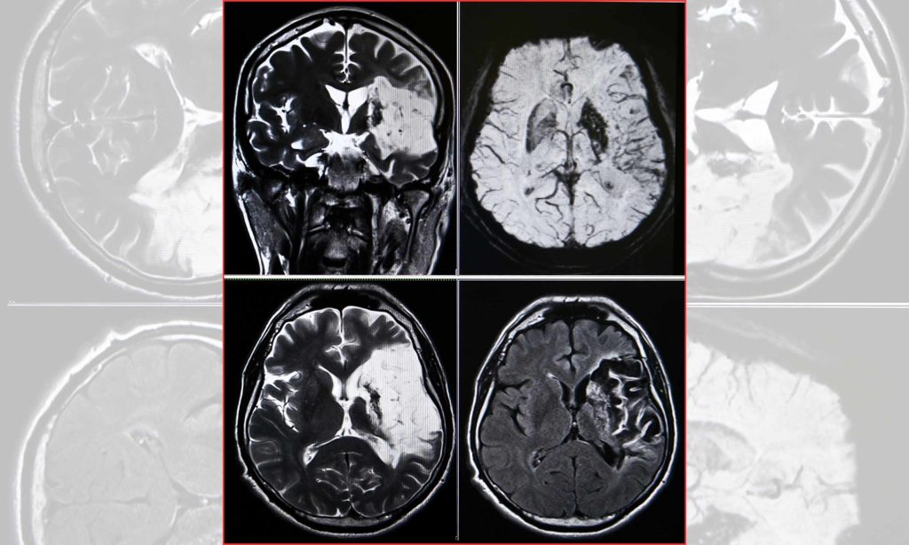 These elements often show up before 99% of heart attacks and strokes.