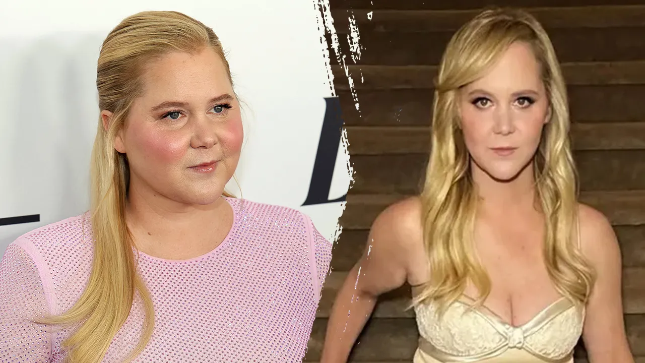 Amy Schumer’s weight loss linked to Cushing's syndrome — here’s what you should know