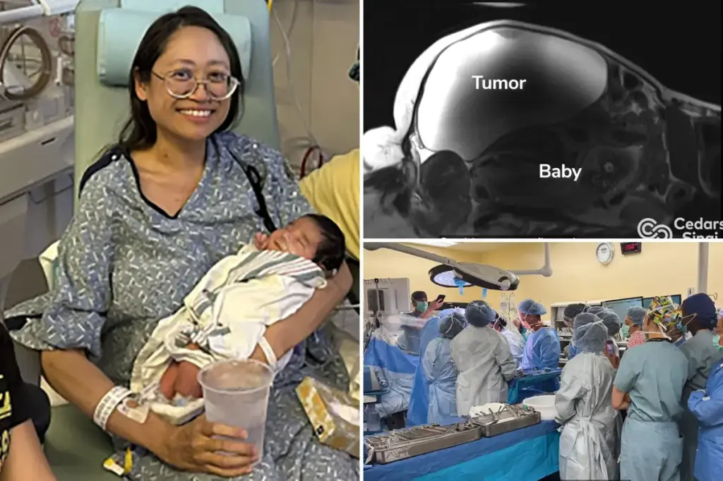 Doctors assist in childbirth while excising a 22-pound tumor from a woman in Bakersfield