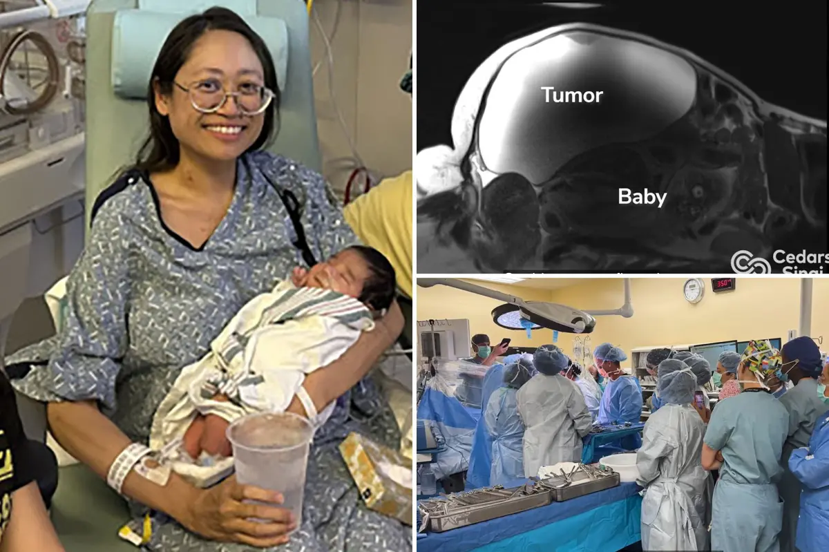 Doctors assist in childbirth while excising a 22-pound tumor from a woman in Bakersfield