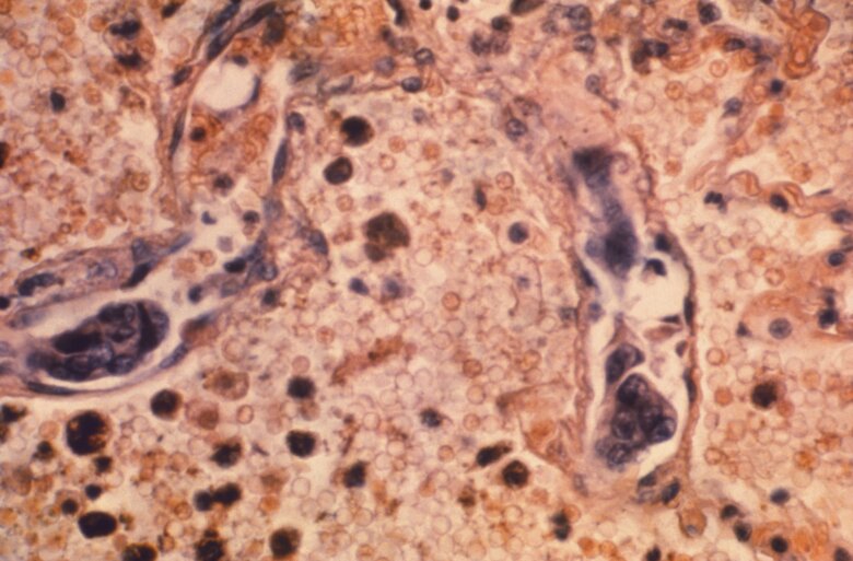 Encouraging findings come from blood tests that detect 50 types of cancer simultaneously.