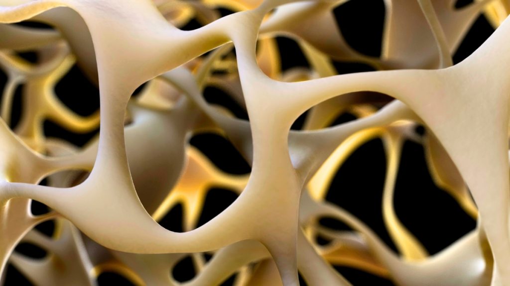 New Advancement in Bone Strengthening May Reverse Osteoporosis