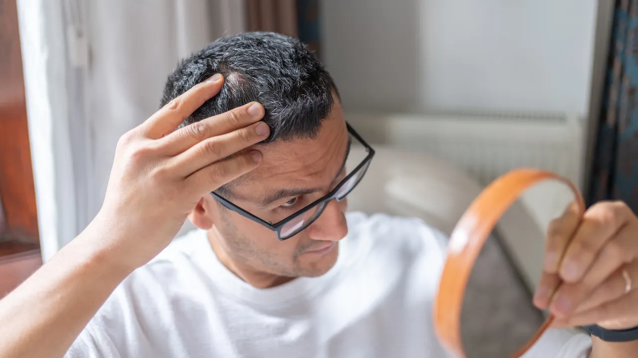 New hair loss therapy demonstrates notable progress compared to the placebo.