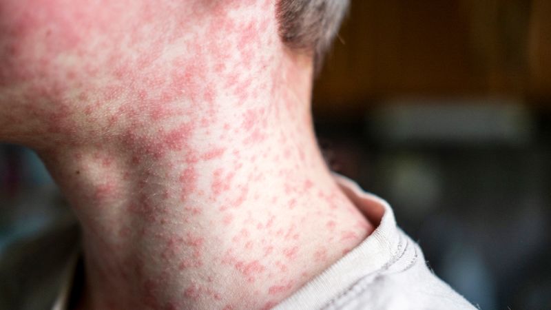 Over 2,000 measles cases recorded in the US this year as continuing outbreaks risk elimination status
