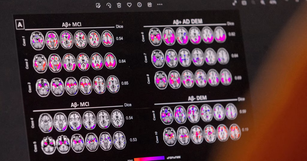 Searching for Alzheimer's medication takes lessons from cancer research's approach of targeting multiple areas.