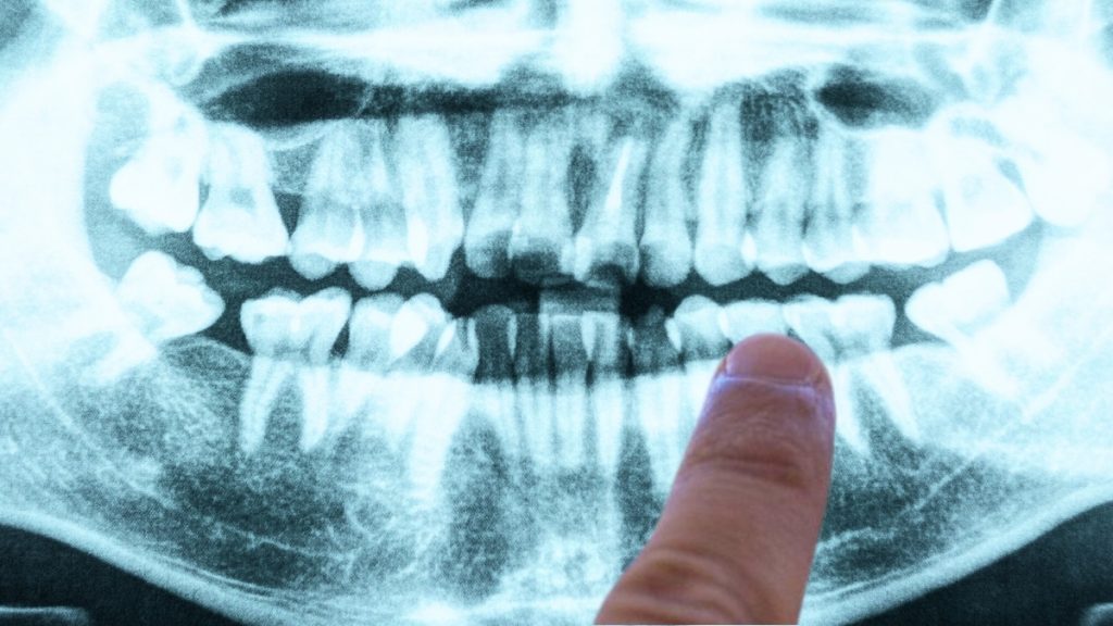 The Source of Alzheimer's Could Be Related to Oral Health