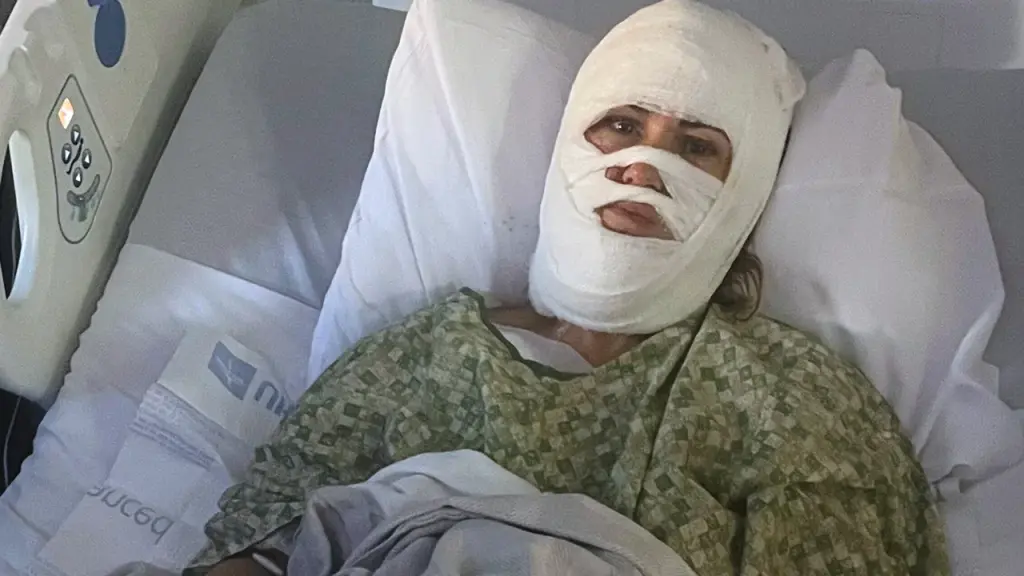 Woman in Georgia hospitalized with third-degree burns from chemical attack