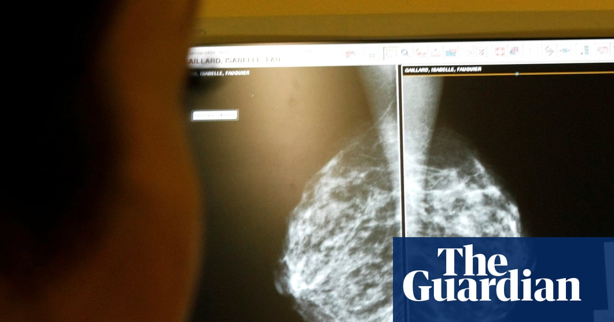 AI in breast cancer screening reduces the likelihood of later diagnosis by 12%, study shows